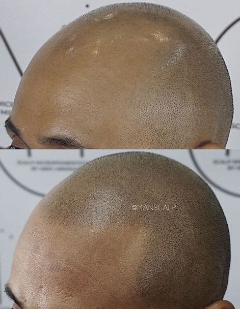 scalp micropigmentation manila philippines|Scalp Micropigmentation (Make Your Hair Look Fuller) .